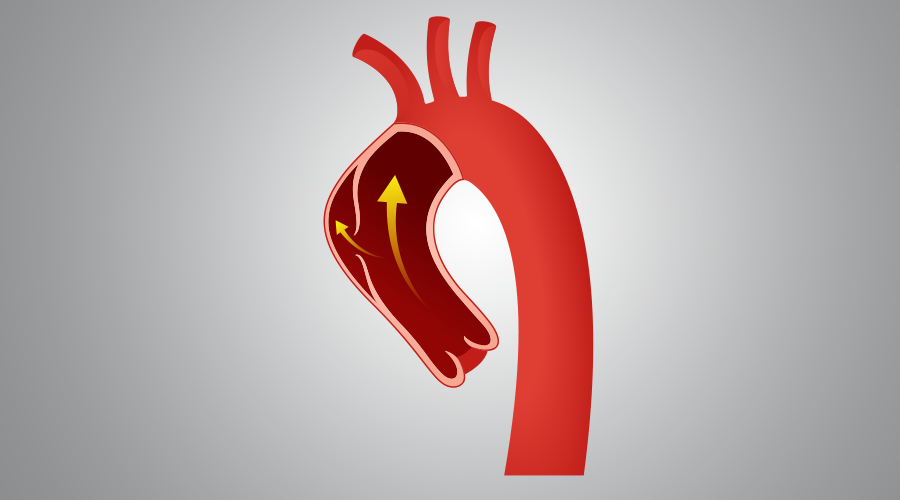 Quais são os Sintomas da Dissecção da Aorta