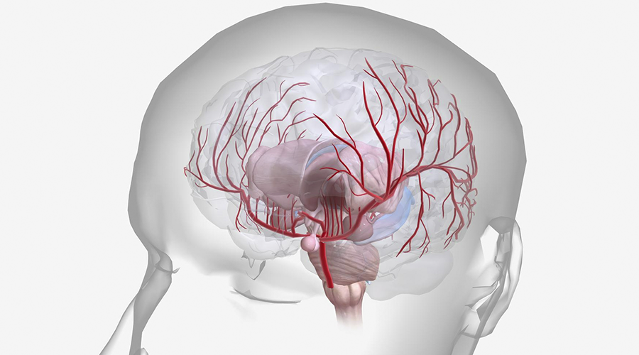 Como tratar um Acidente Vascular Cerebral (AVC)