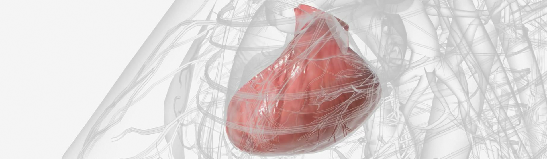 Aneurisma Ventricular