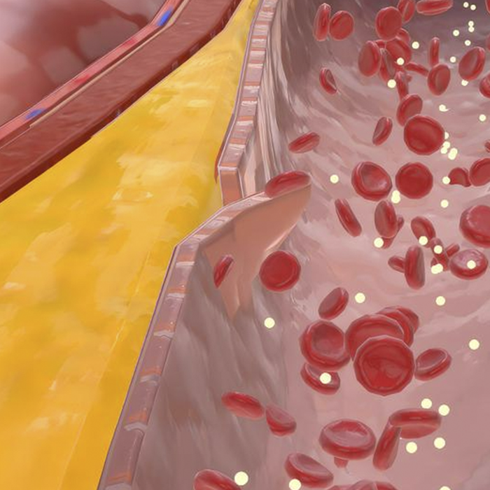 Dissecção da Aorta