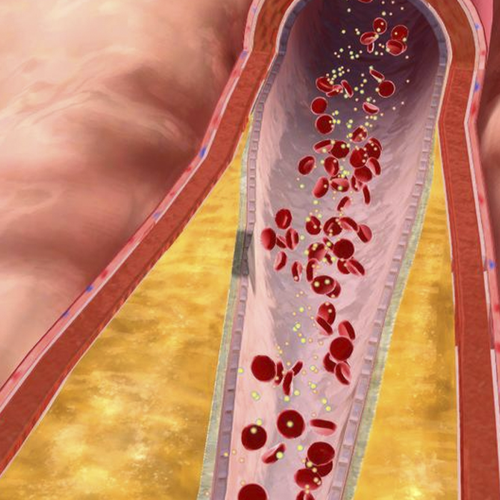 Doença Arterial Coronariana (DAC)