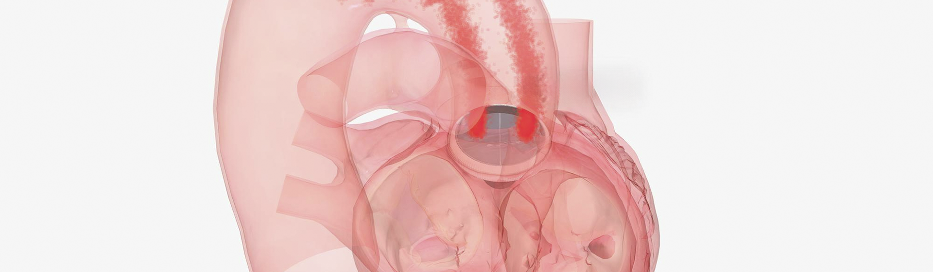 Endocardite Infecciosa