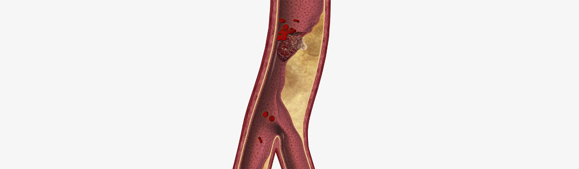 Infarto Agudo do Miocardio