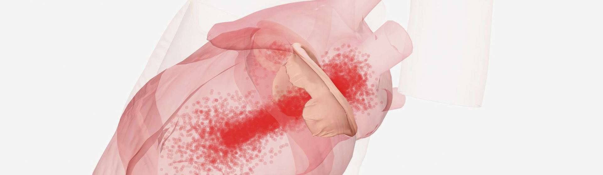 Insuficiência Mitral