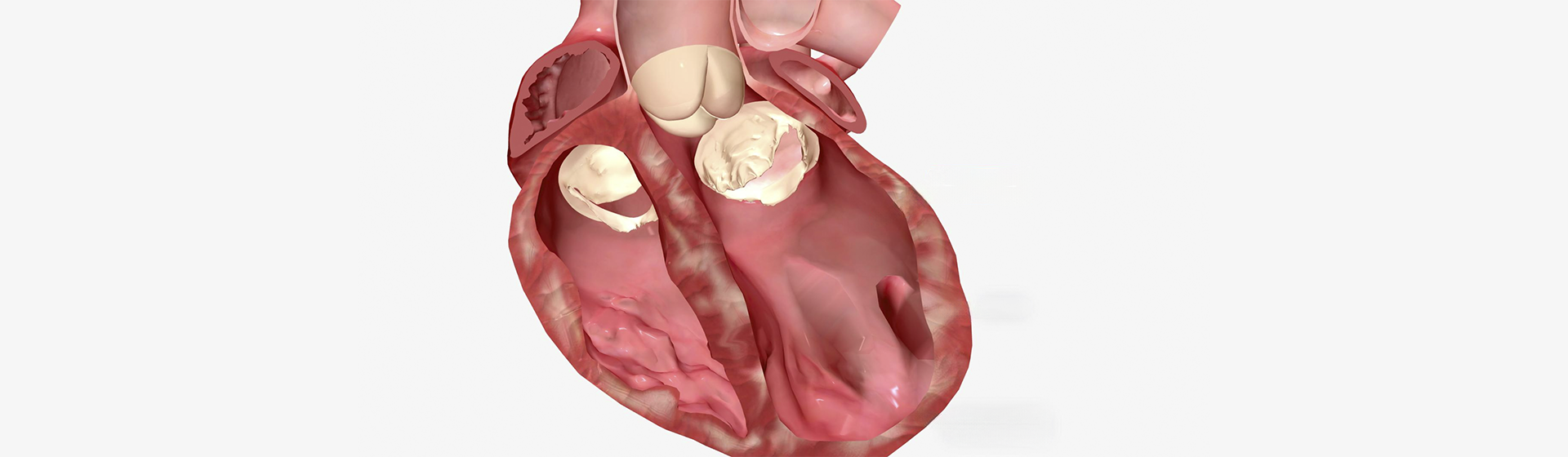 Miocardiopatia Dilatada