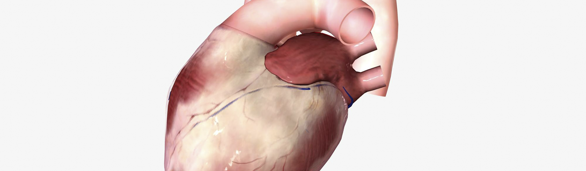 Miocardiopatia Induzida por Álcool