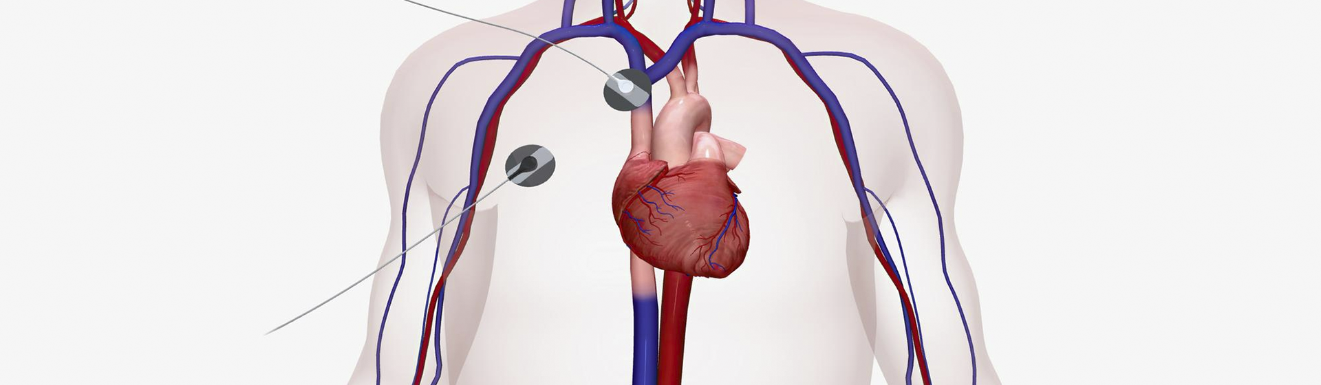 Miocardiopatia Induzida por Quimioterapia
