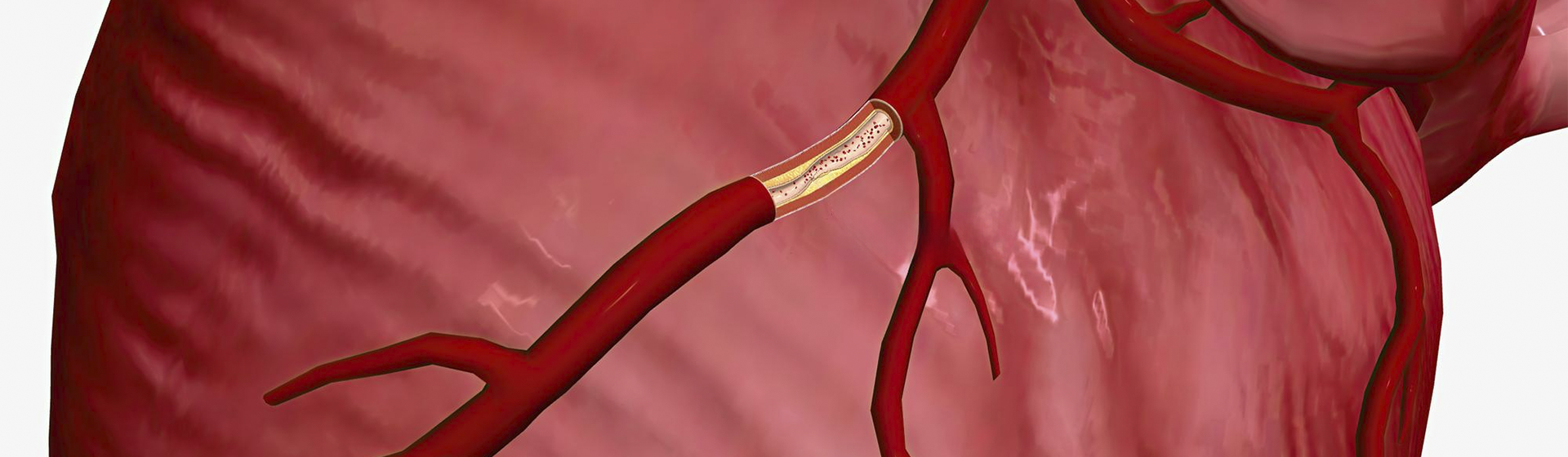 Miocardiopatia isquêmica