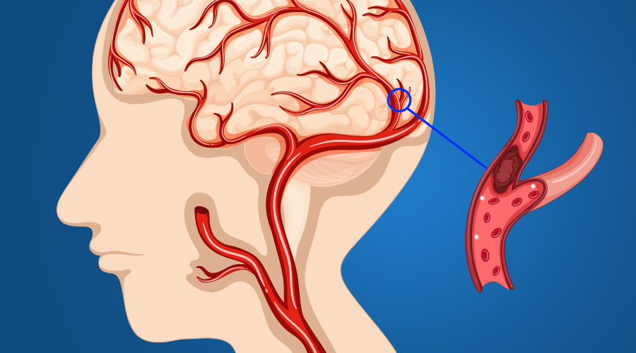 Relação Entre Hipercolesterolemia e Acidente Vascular Cerebral